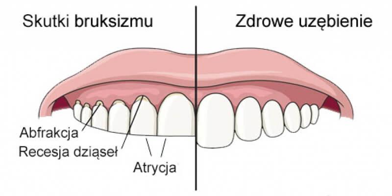 Sposoby ‌diagnozy bruksizmu: jak rozpoznać problem