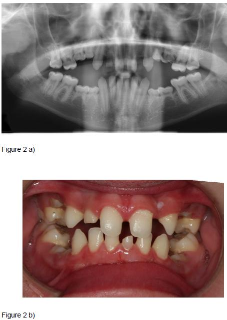 Zalecenia dotyczące ⁤opieki ‌dentystycznej dla ⁣osób z zespołem Williamsa