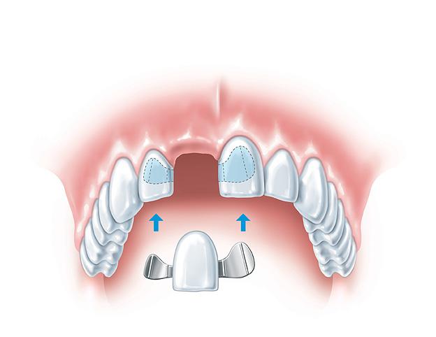 Wady mostów dentystycznych a długoterminowe zdrowie jamy⁢ ustnej