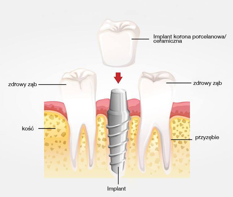 Zrozumienie‍ implantów dentystycznych w kontekście zdrowia jamy ustnej