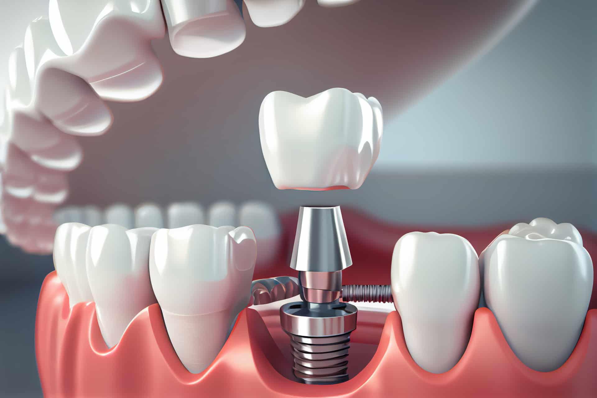 Praktyczne⁤ wskazówki dla osób rozważających implantację dentystyczną