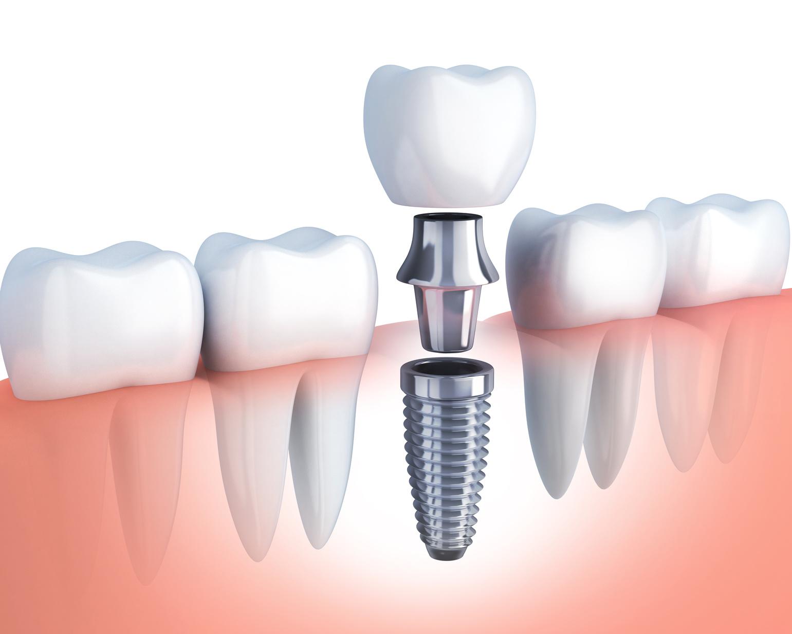 Potencjalne ryzyka i ograniczenia związane z implantami dentystycznymi