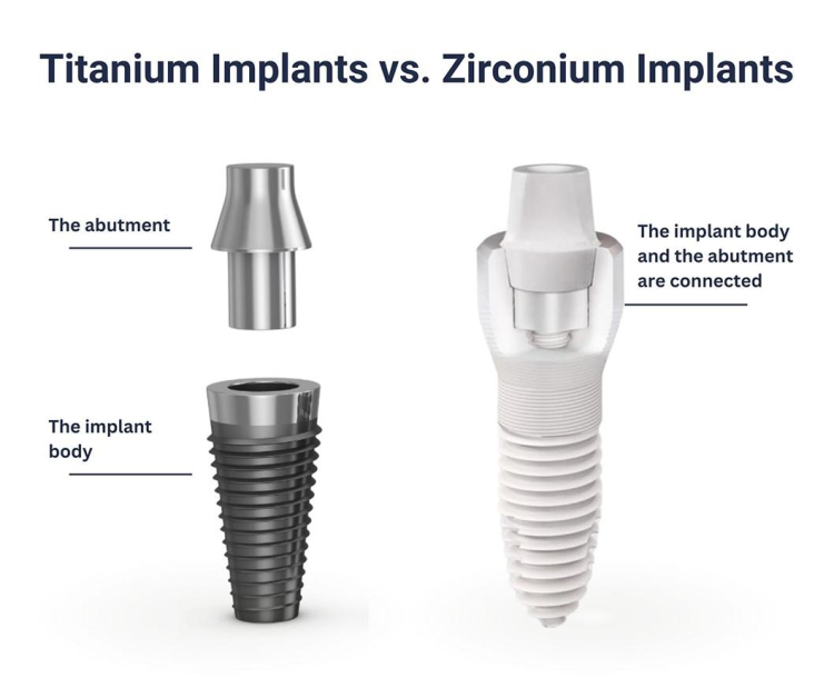 Jakie są zalety i wady implantów tytanowych?