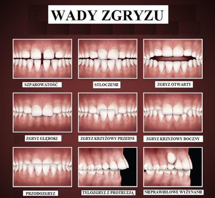 Jakie są najczęstsze przyczyny nieprawidłowego zgryzu?