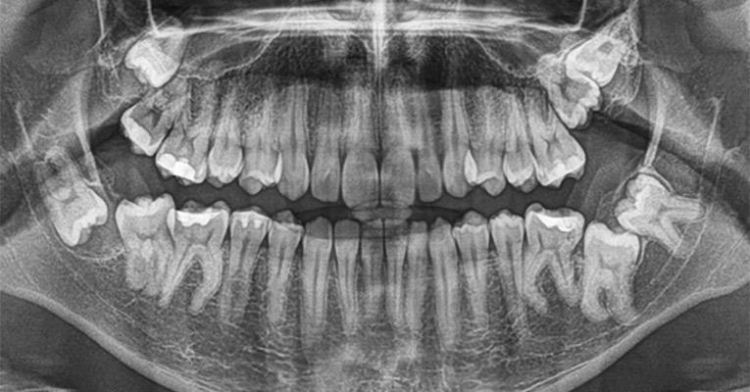 Odbudowa kości w stomatologii – dlaczego jest konieczna przed implantacją?