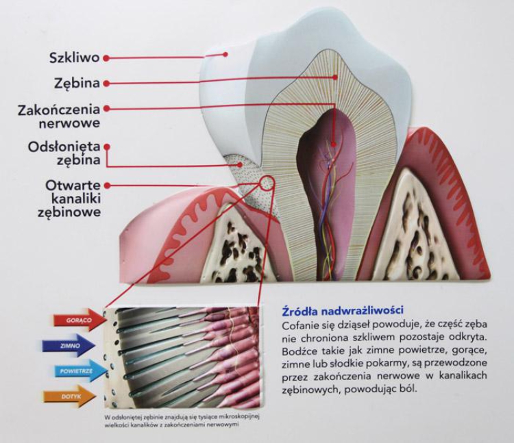 Jakie są najlepsze metody leczenia nadwrażliwości zębów?