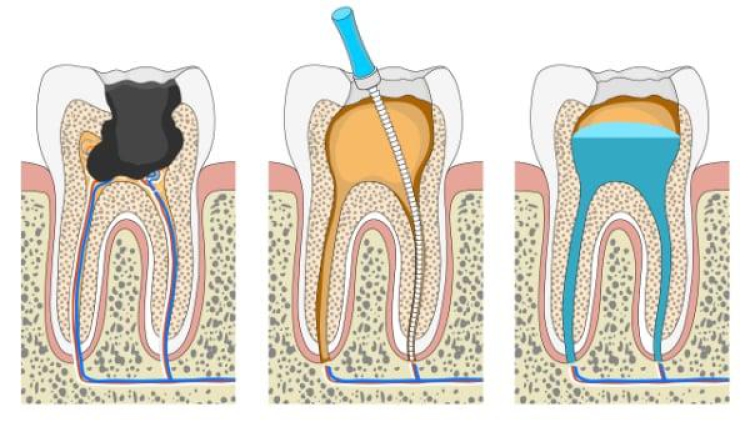 Leczenie endodontyczne zębów mlecznych – co warto wiedzieć?