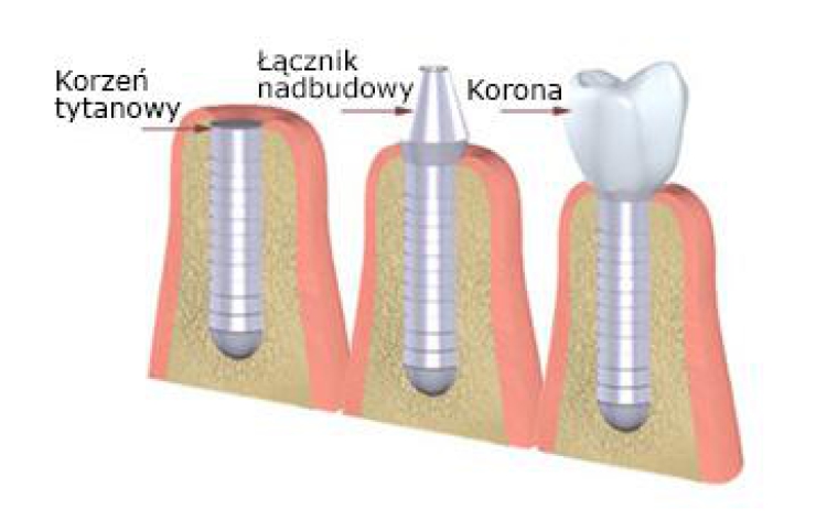 Jak długo trwa proces zakładania implantów dentystycznych?