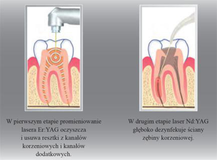 Laserowe leczenie próchnicy – jak działa i jakie są jego zalety?