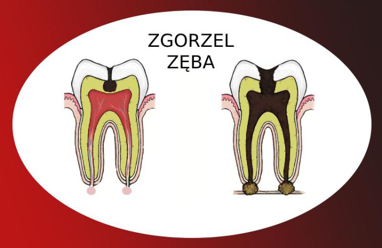 Leczenie martwicy zębów – jakie są opcje?