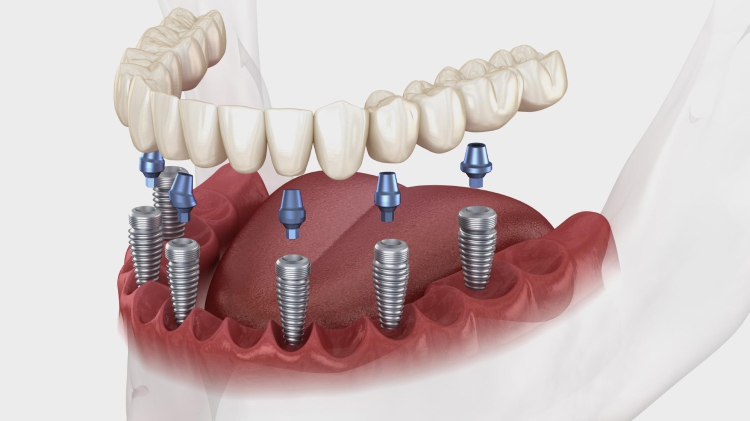 Zabieg wszczepienia implantu w Katowicach: Ceny od 3000 do 6000 zł