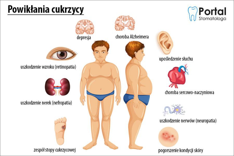 Czy osoby z cukrzycą powinny mieć specjalną opiekę dentystyczną?