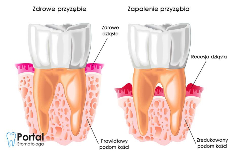 Jakie są objawy infekcji przyzębia?