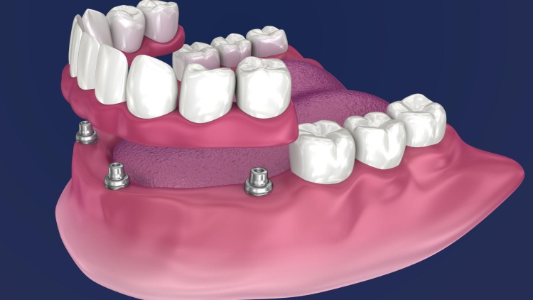 Protezy typu overdenture – kiedy są najlepszym rozwiązaniem?