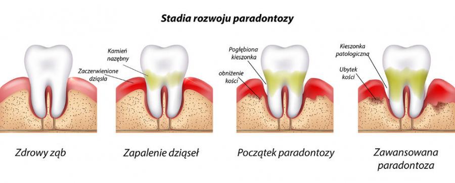 Jakie są objawy choroby przyzębia?