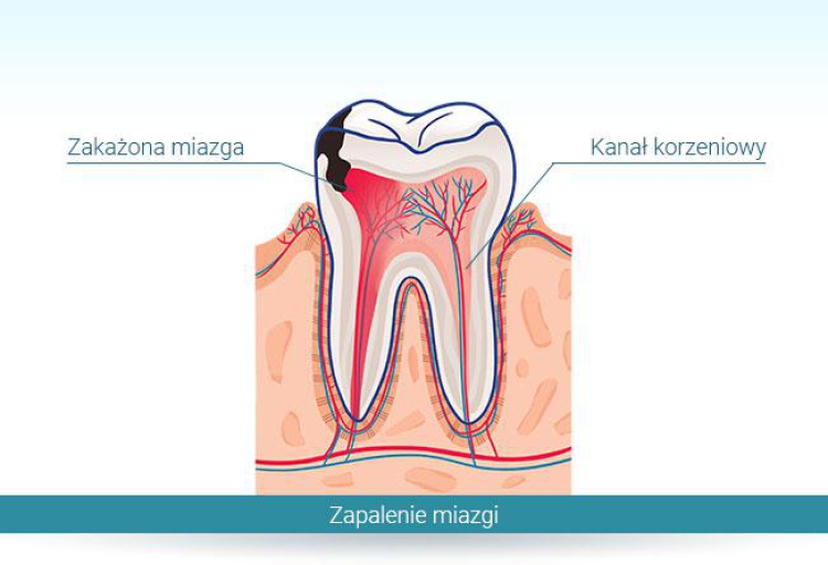 Czy istnieją naturalne sposoby na złagodzenie bólu zęba?