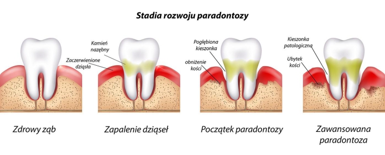 Jakie są najlepsze metody leczenia nadwrażliwości dziąseł?