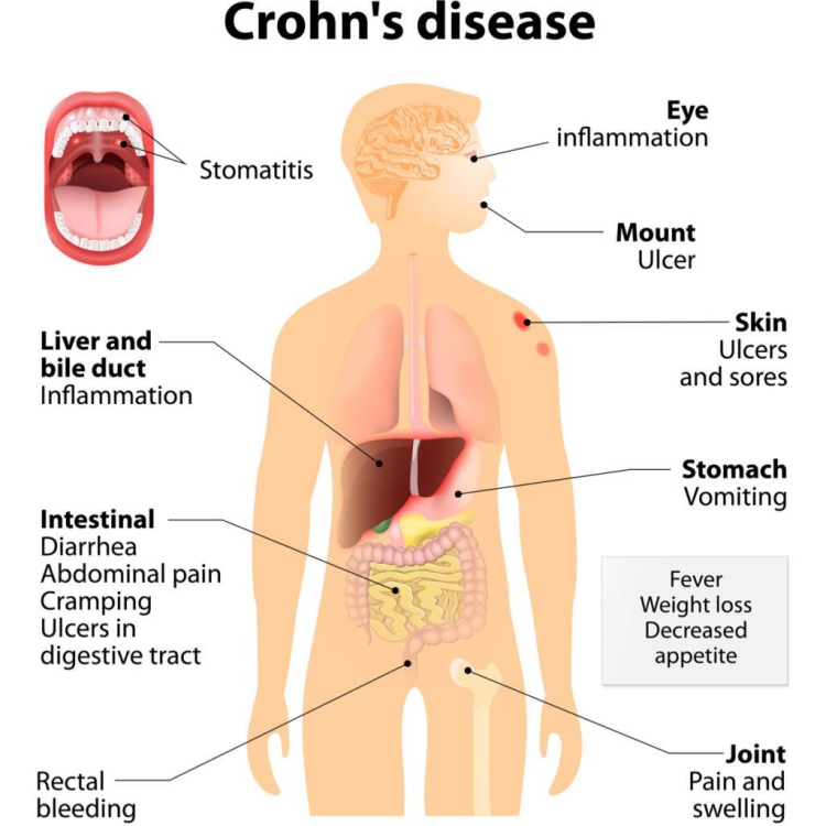 Jakie są objawy choroby Crohna w jamie ustnej?
