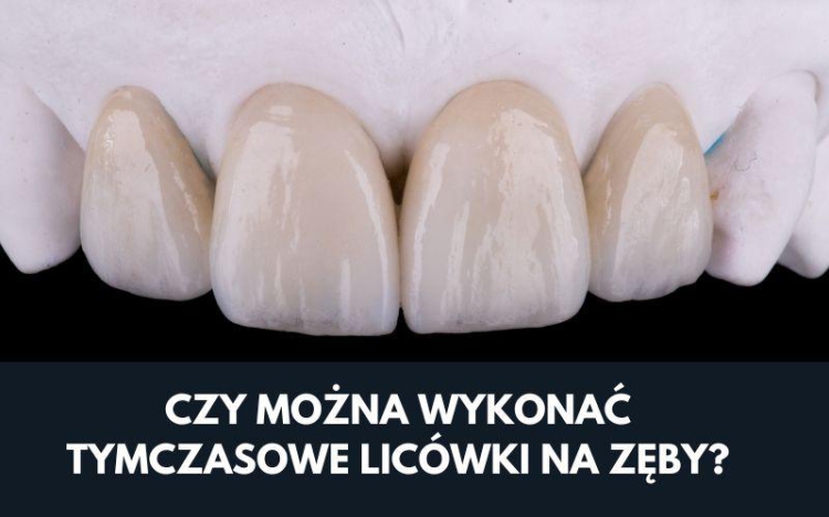 Jak długo można nosić tymczasowe licówki?