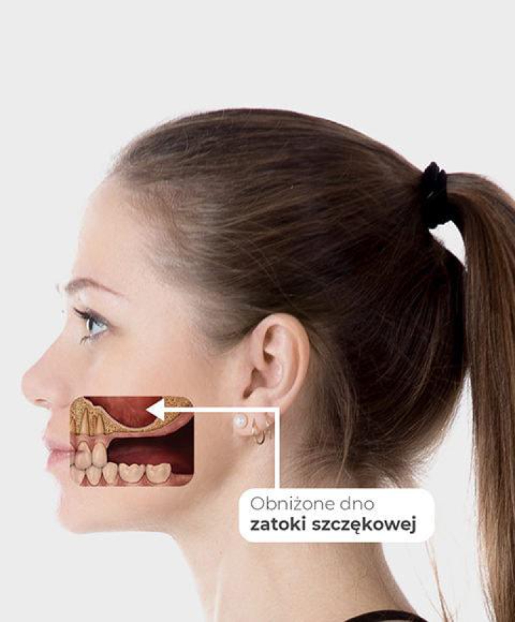 Zabieg podnoszenia dna zatoki szczękowej we Wrocławiu: Koszt od 2000 do 5000 zł