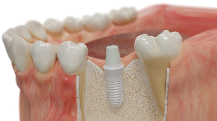 Jakie są zalety i wady implantów ceramicznych?